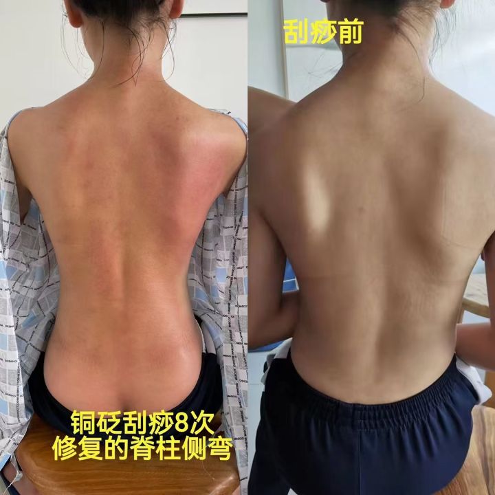 刮痧001.jpg